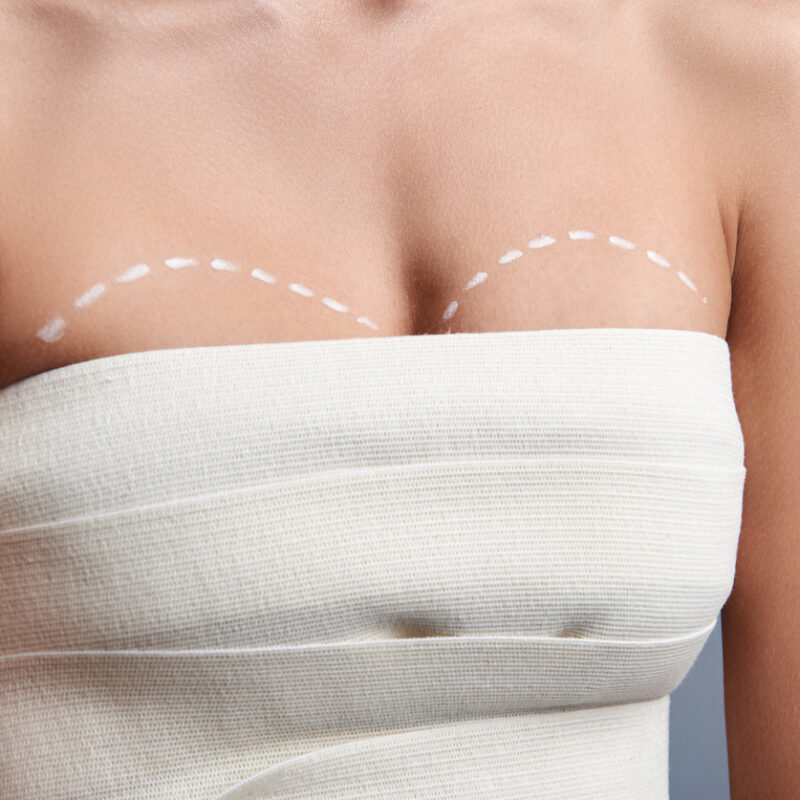 Mastopexia sem Prótese