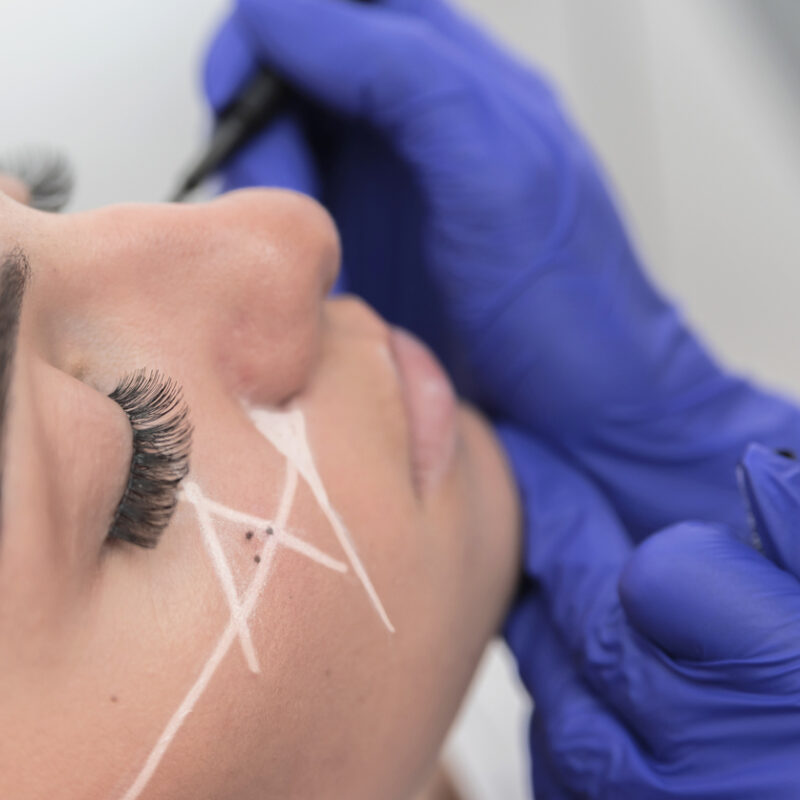 Lifting com Blefaroplastia