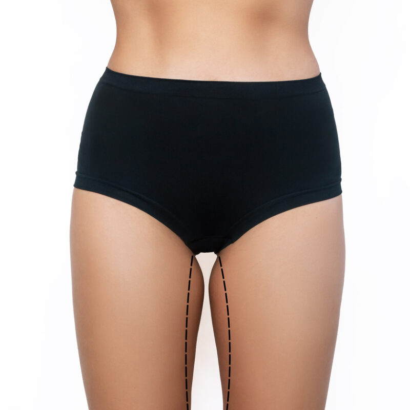 Dermolipectomia de Coxas (Lifting de Coxas)