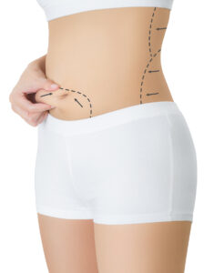 tipos de abdominoplastia