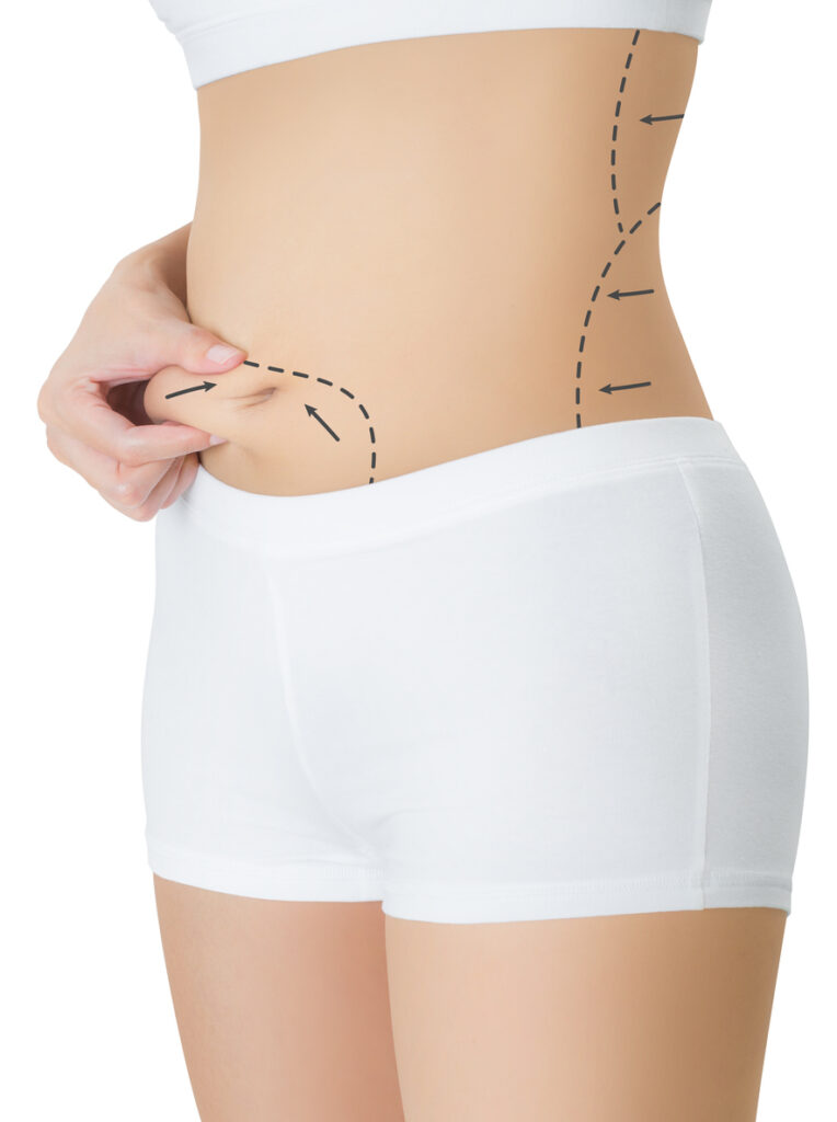 tipos de abdominoplastia