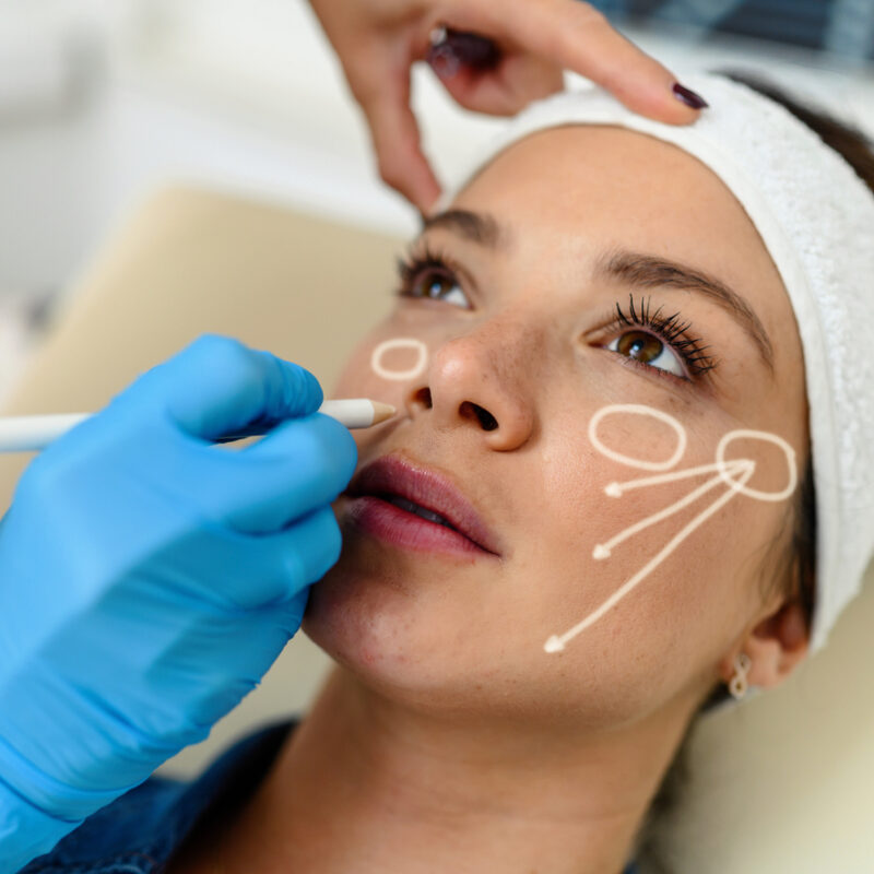 Ritidoplastia (Mini Lifting)