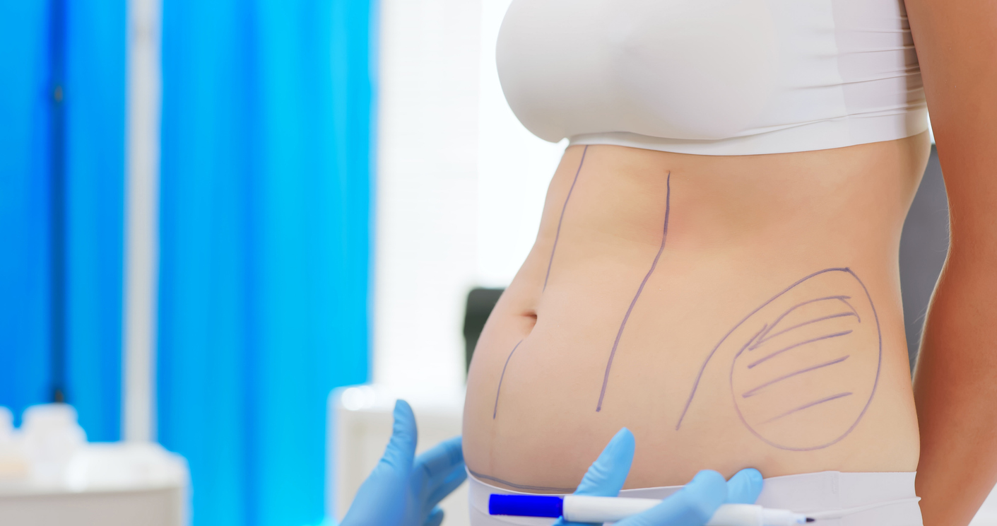 Qual é melhor, abdominoplastia ou lipo - Clinica Infinty