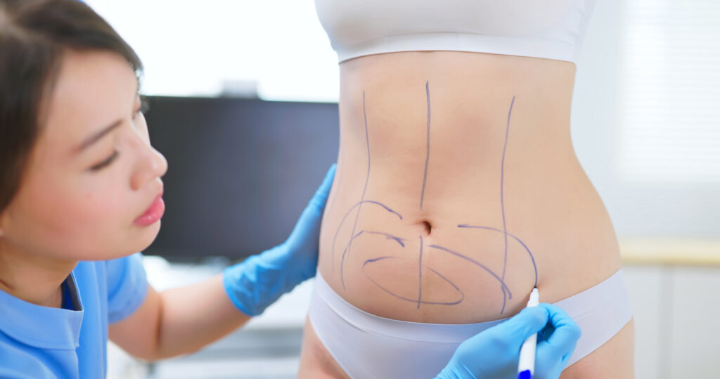 Qual é melhor, abdominoplastia ou lipo - Clinica Infinty