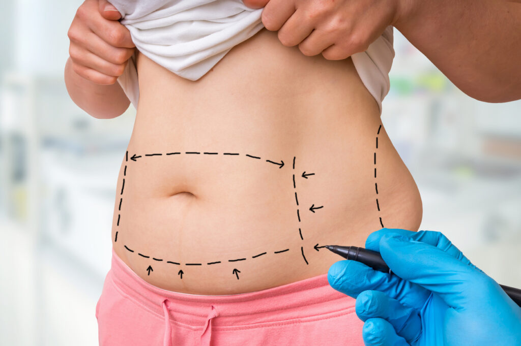 Qual é o valor de uma lipoabdominoplastia