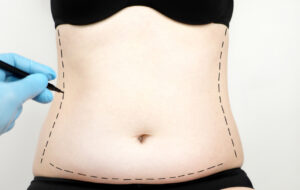Qual o risco de uma lipoabdominoplastia?
