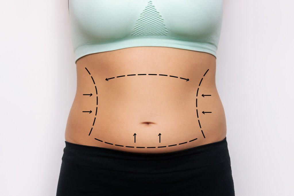 Quanto tempo dura uma lipoabdominoplastia?
