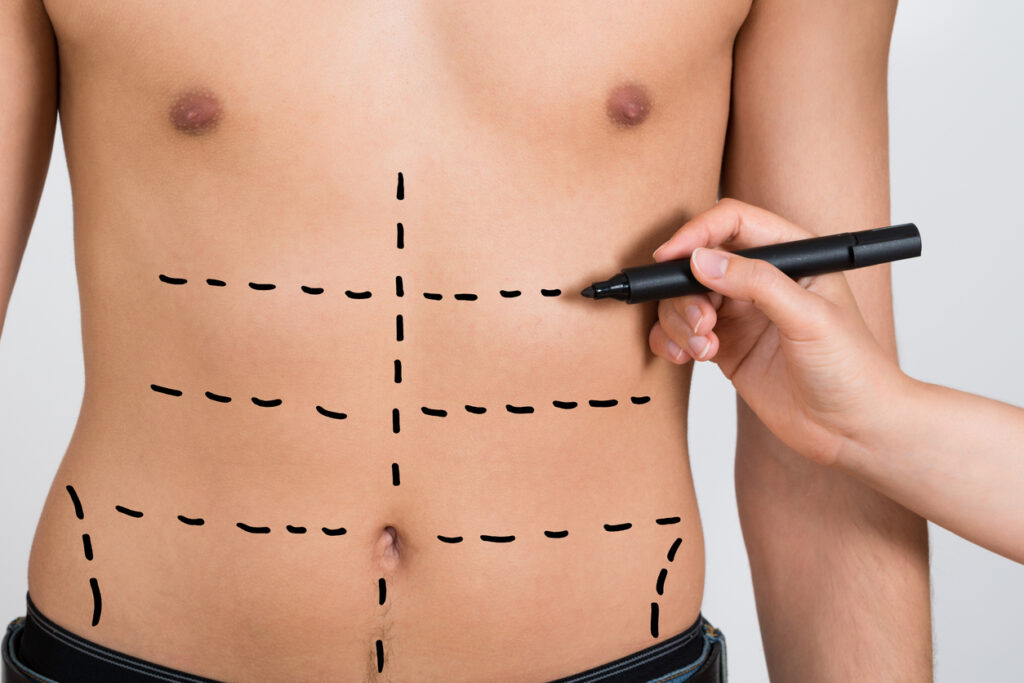 Quem tem direito de fazer abdominoplastia pelo SUS?