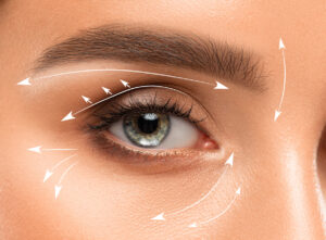 O que é Blefaroplastia?