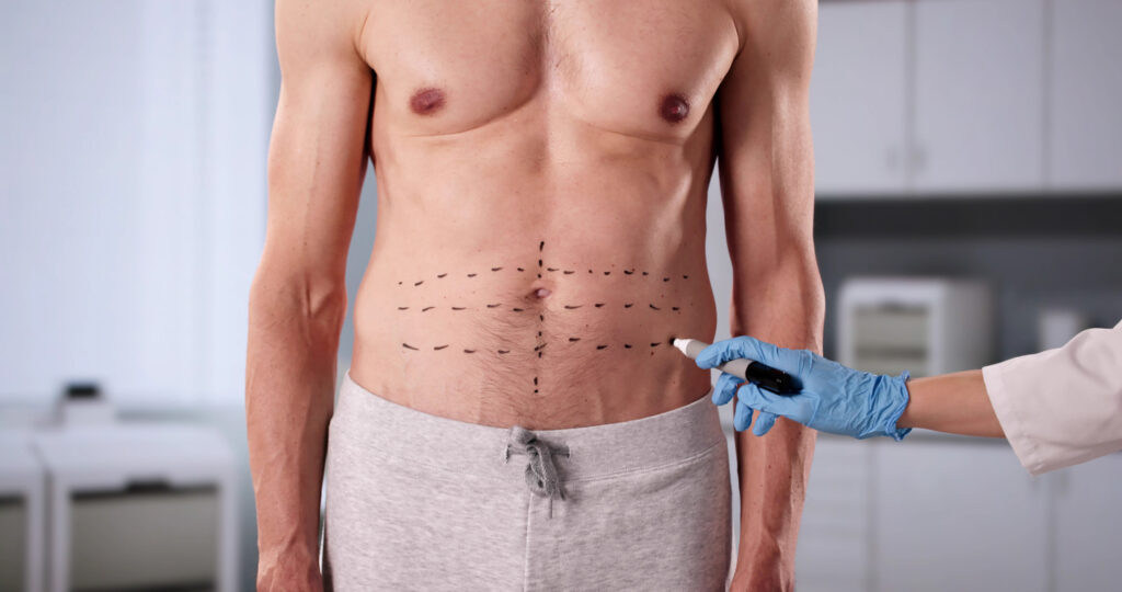 Como Fica o Corpo Após a Abdominoplastia?