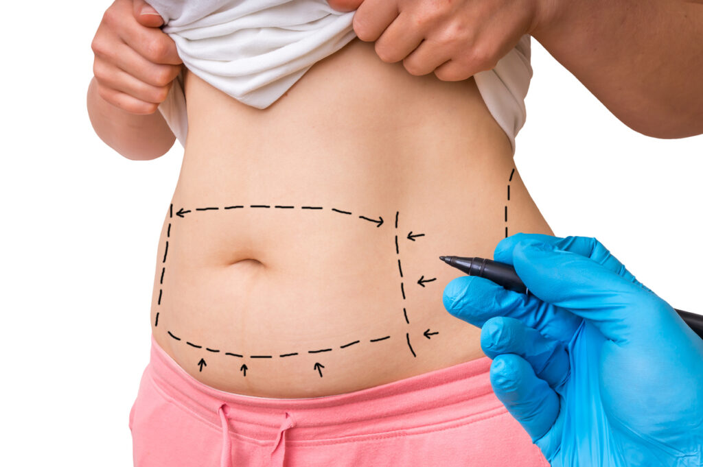 Qual a diferença da abdominoplastia para lipoabdominoplastia?