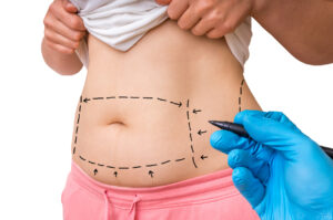 Qual a diferença da abdominoplastia para lipoabdominoplastia?