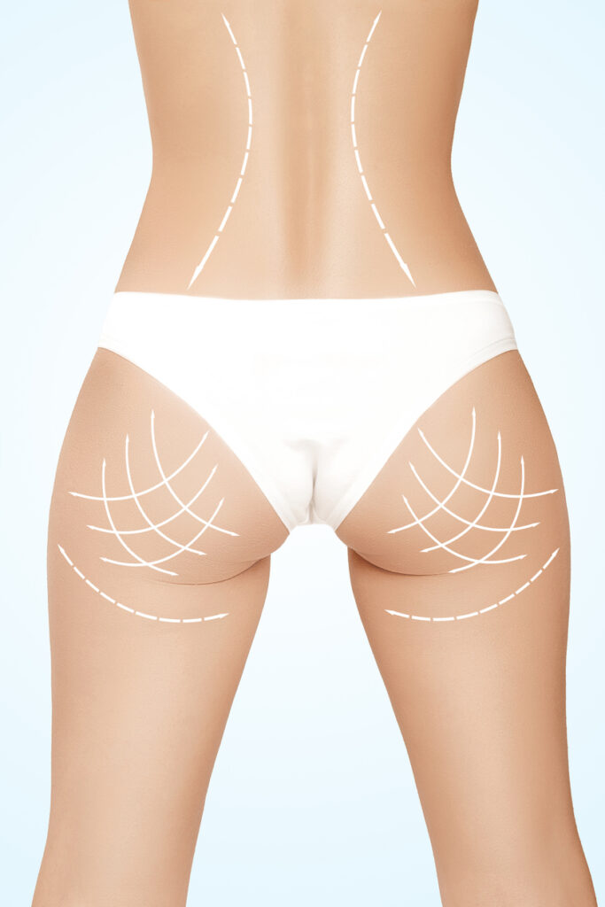 Torsoplastia: Entenda o Que É e Quais os Tipos Existentes