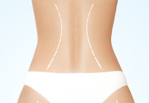 Torsoplastia: Entenda o Que É e Quais os Tipos Existentes