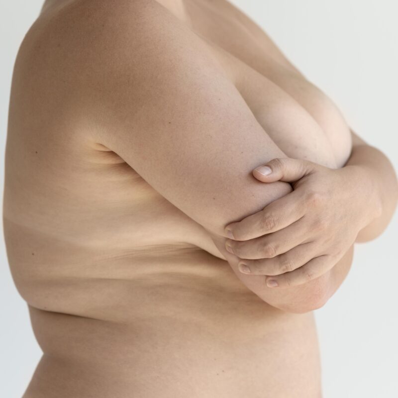 Explante + Mastopexia sem Prótese